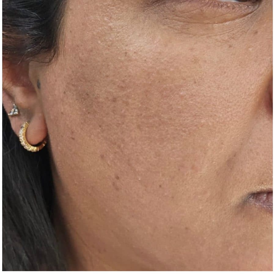 Skin after eighteen days of use — smoother, more even tone